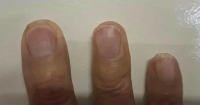 fingernails 