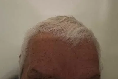 forehead 