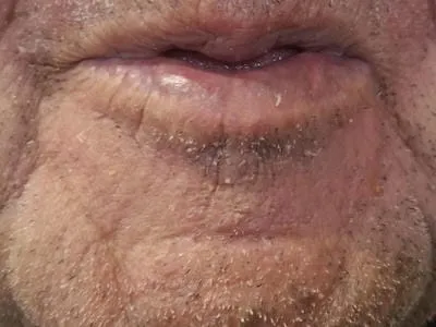 lower lip